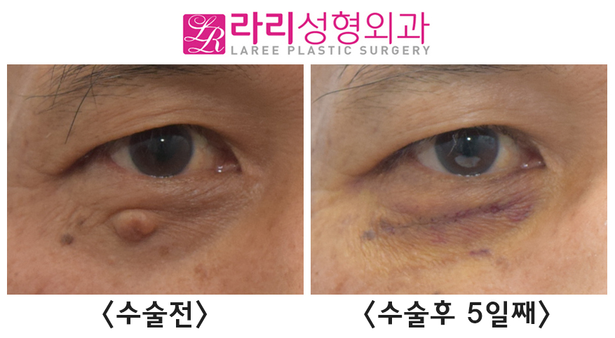 [Rari Plastic Surgery] Comparison of Before-and-After Photos of a Facial Wart Mole, Wart Lump Removal Surgery image 1