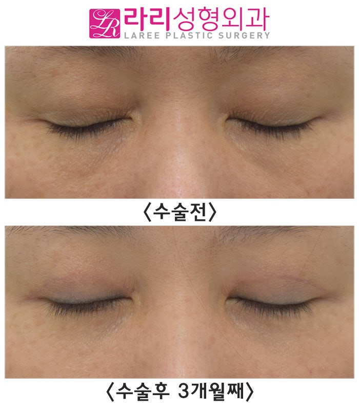 [라리성형외과] 절개눈매교정으로 윗눈꺼풀패임 개선될까?! (+ 눈밑지방재배치수술 ) 관련 이미지 4