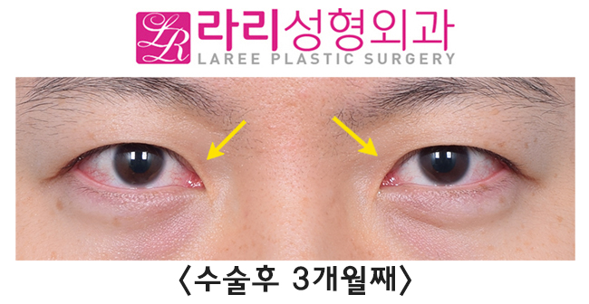 [Rari Plastic Surgery] Recovery Process for Line Irregularity During the Course of Double Eyelid Removal Surgery image 4
