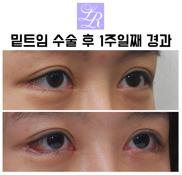If You Want an S-Line Under Your Eyes, Try Lower Eye Widening image 11