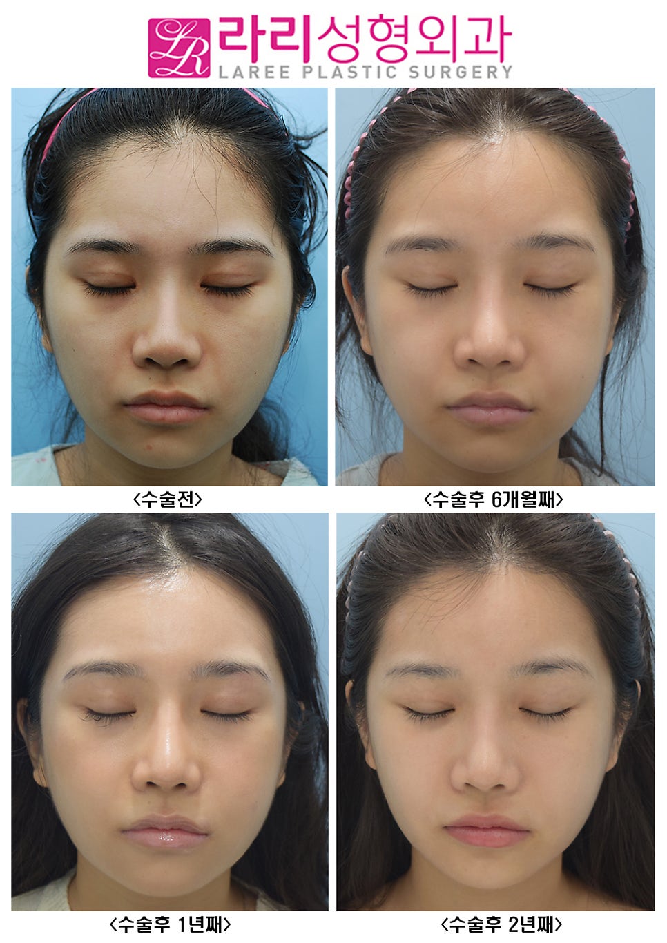 [Lari Plastic Surgery] Effective and Natural Canthoplasty for Lowering the Outer Eye Corner Without Lower Canthoplasty Surgery: Before-and-After Photos Up to 2 Years image 4