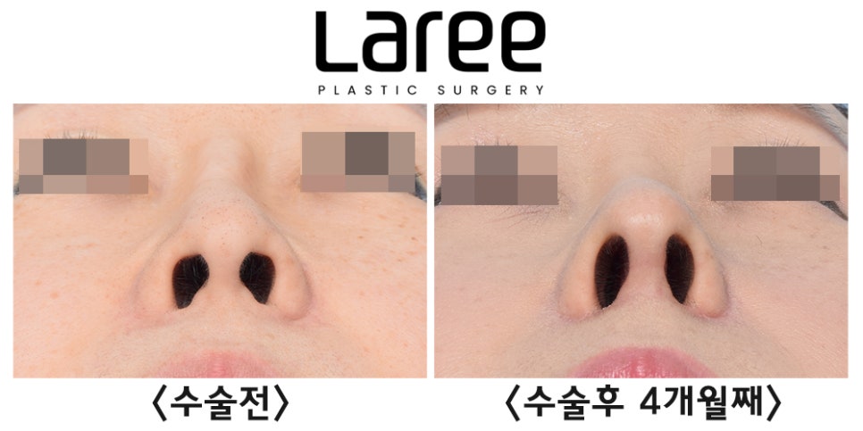 [라리성형외과] 고양이수술과 인중축소수술을 병행한 자가늑 코재수술(+콧대영구필러제거) 관련 이미지 3