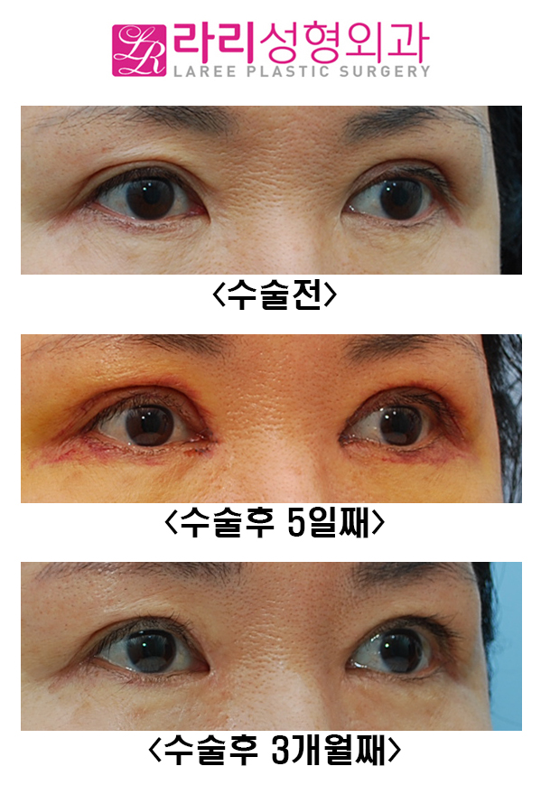 [라리성형외과] 두꺼운 소세지눈 교정 관련 이미지 4