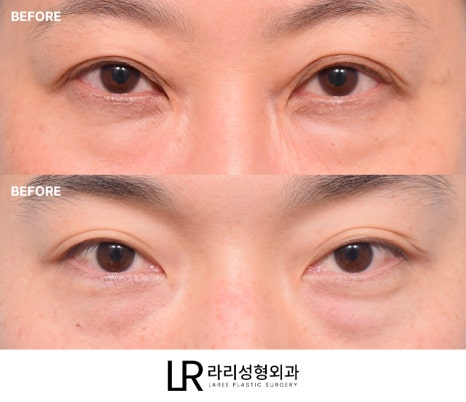 [라리성형외과] 하루(1DAY) 투자로 예뻐지는 라리성형외과의 퀵 눈밑지방재배치수술 관련 이미지 2
