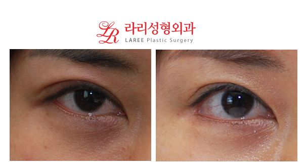 Lateral Canthoplasty for Lowering the Outer Eye Corners / Outer Corner Lowering Revision Canthoplasty: 2 Years After Surgery image 1
