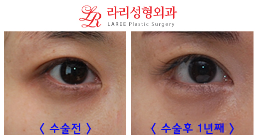 Epicanthoplasty: Is It Worth the Cost? image 1
