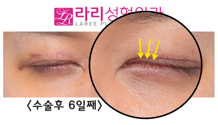 [라리성형외과] 쌍꺼풀없애기수술은 쌍꺼풀을 없애주는 겁니다. 관련 이미지 5