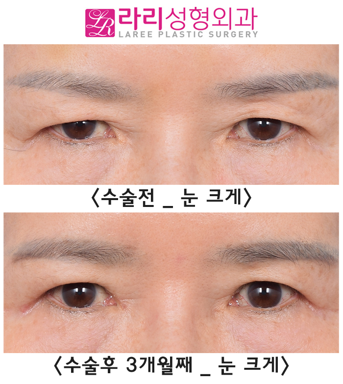 [Rari Plastic Surgery] Why You Should Get Forehead Botox Before Upper Blepharoplasty, as Seen in Before-and-After Photos image 4