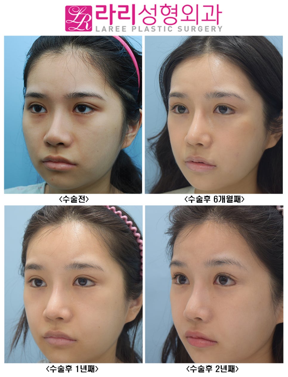 [Lari Plastic Surgery] Effective and Natural Canthoplasty for Lowering the Outer Eye Corner Without Lower Canthoplasty Surgery: Before-and-After Photos Up to 2 Years image 3