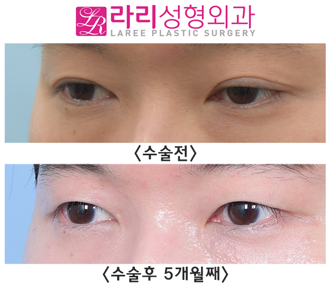 [라리성형외과] 나는 쌍꺼풀없애는수술을 하면 어떻게 될까? 관련 이미지 3