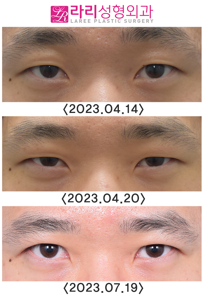 [라리성형외과] 이마보톡스가 눈 모양이나 쌍꺼풀 라인에 미치는 영향에 대하여 관련 이미지 1