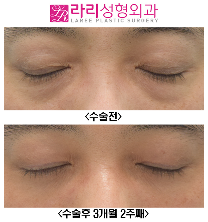 [라리성형외과] 피곤해보이는 여러겹 자연쌍꺼풀없애기와 눈밑지방재배치 수술 전후 관련 이미지 2