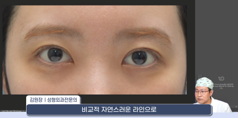 [라리성형외과] 쌍꺼풀재수술 라인 낮추는 두 가지 수술법 (절제방법 , 두줄따기방법) 관련 이미지 16