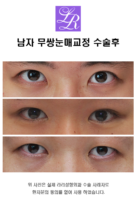 남자 눈도 뒷트임 할 수 있나요? 관련 이미지 4
