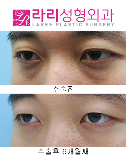 [Lari Plastic Surgery] Removing Double Eyelids After Multiple Buried Double-Eyelid Surgeries image 5