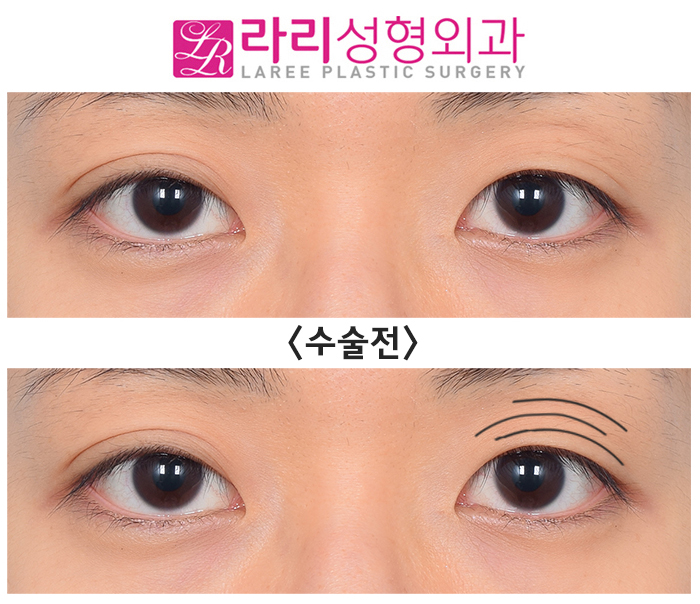 [라리성형외과] 겹주름 쌍꺼풀을 잘 없애려면 피할 수 없는 상안검외반, 좋아질 수 있어요. 관련 이미지 5