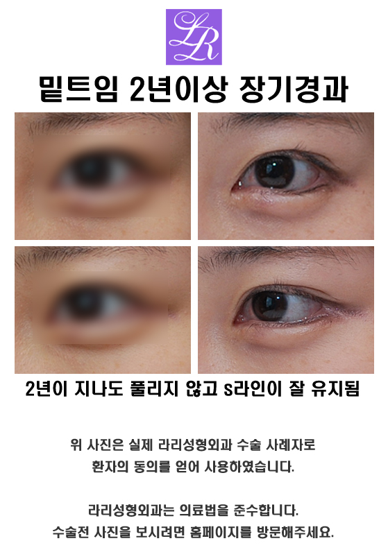If You're Curious About Side Effects of Lower Eye Corner Surgery (feat. Conjunctival Edema) image 5