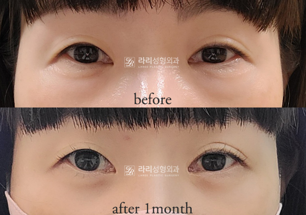 [Lari Plastic Surgery] For Bulging Under-Eyes That Eye Bag Creams / Eye Bag Patches Can’t Fix: Lower Eyelid Fat Repositioning! image 2