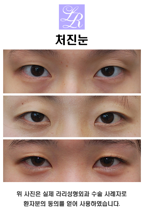 안검하수 눈매교정술 해야하는 경우 관련 이미지 1