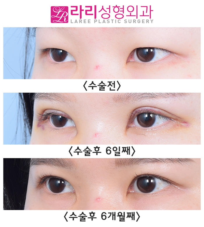 [Lari Plastic Surgery] Incisional Eye Correction Surgery for a Hidden Double Eyelid in a Monolid: Swelling Period Before and After (+Selfie) image 3