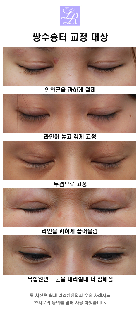 쌍커플 재수술 잘하는 병원 찾아가기 관련 이미지 2