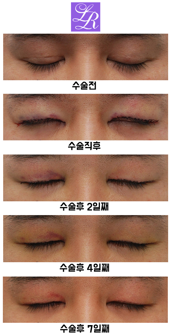 쌍꺼풀푸는수술 후기 - 수술후 1주일차 붓기, 멍 경과 관련 이미지 4