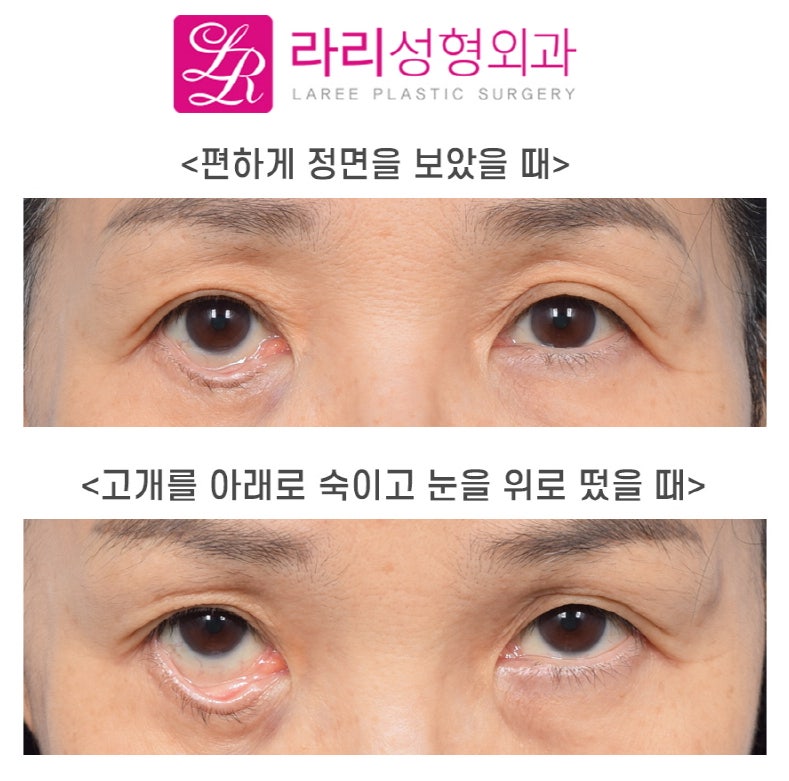 [Laree Plastic Surgery] My Eyelid Margin Is Turned Out—Could This Be Ectropion?!! (Self-Check by Symptoms) image 4