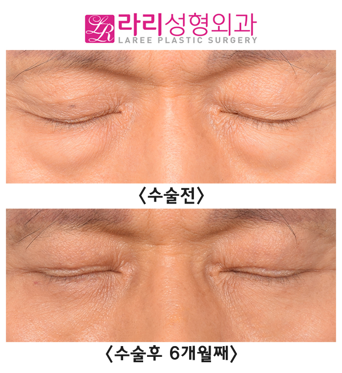 [Lari Plastic Surgery] Correction Surgery Before and After for Old Double Eyelid Surgery Side Effects, Sagging Skin, and Multiple Folded Double Eyelids image 4