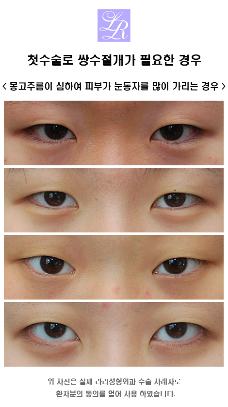 After Looking at Reviews of Incisional Double Eyelid Surgery image 2