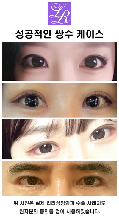 Double eyelid surgery with an inner crease as charming as an outer crease image 6