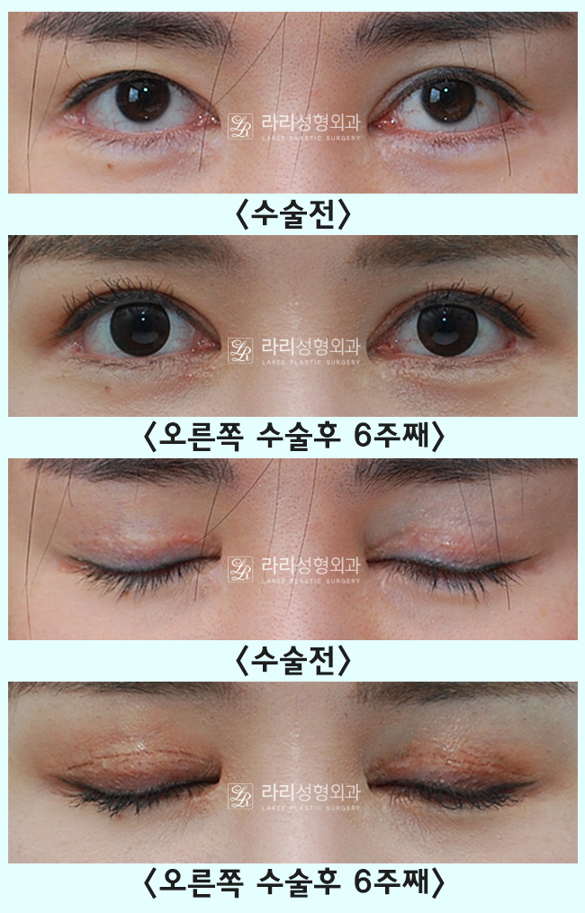 [Lari Plastic Surgery] One-sided double eyelid surgery to correct uneven eyes: Is it possible to get double eyelids on only one eye? image 3