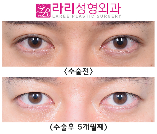 [라리성형외과] 완전 두꺼운 자연쌍꺼풀 무쌍 만들기 관련 이미지 1