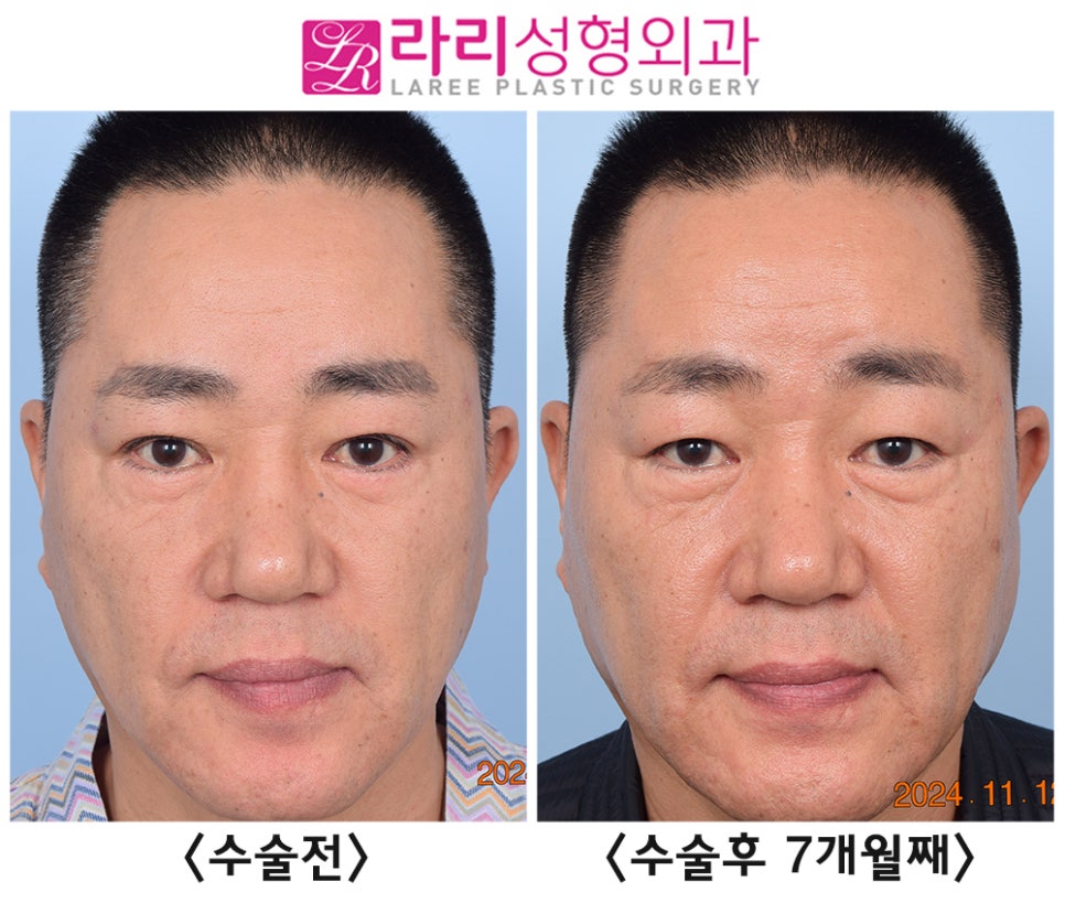 [Rari Plastic Surgery] Comparing Before and After Photos of Double Eyelid Removal Surgery (Double Eyelid Disappearance + Mucosal Ptosis Correction) image 3