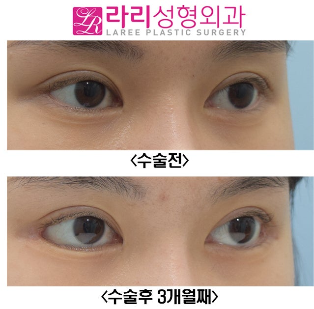 [라리성형외과] 효과 확실한 눈꼬리내리기뒤트임수술 단기 경과 전후 사진 관련 이미지 3