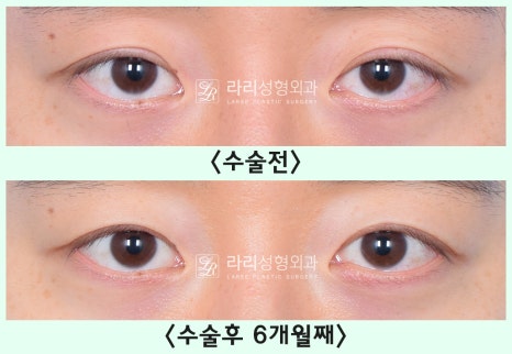 [Lari Plastic Surgery] Removing a Visible Double Eyelid (Double Eyelid Reversal Surgery), From Natural Double Eyelids to Surgical Double Eyelids: A to Z image 17