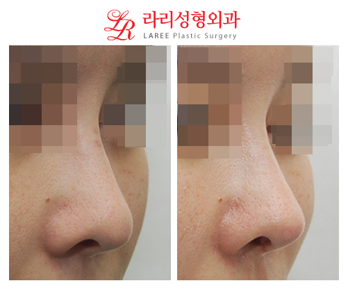 Before and After Photos of Revision Tip Rhinoplasty for a Collapsed Nasal Tip image 2