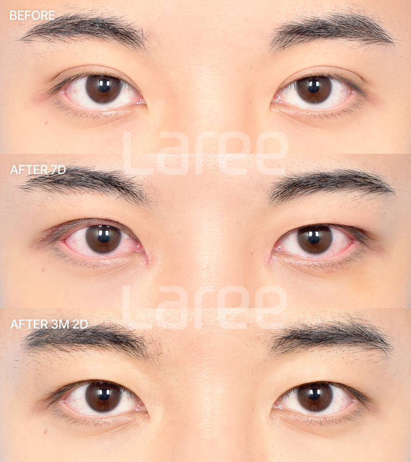 [Lari Plastic Surgery] Everything About Double Eyelid Removal Surgery image 12