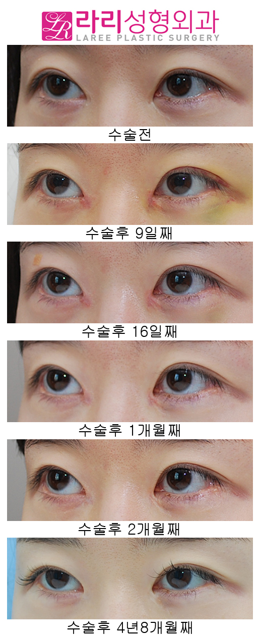 앞트임복원 수술 후 4년8개월 장기경과 관련 이미지 3