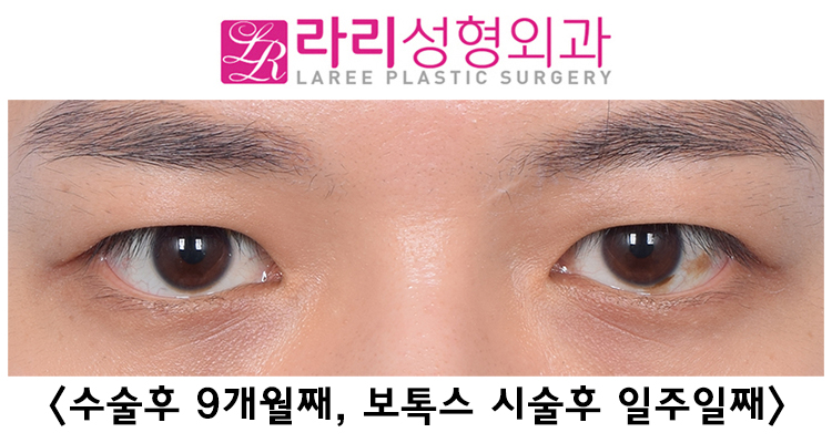 [Lari Plastic Surgery] Correcting Uneven Eyes with Forehead Botox After Double Eyelid Removal Surgery image 4