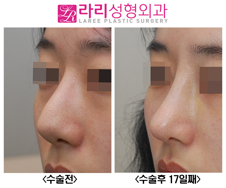 [라리성형외과] 꺾인 콧대 낮은 코끝 살리는 코재수술 관련 이미지 3