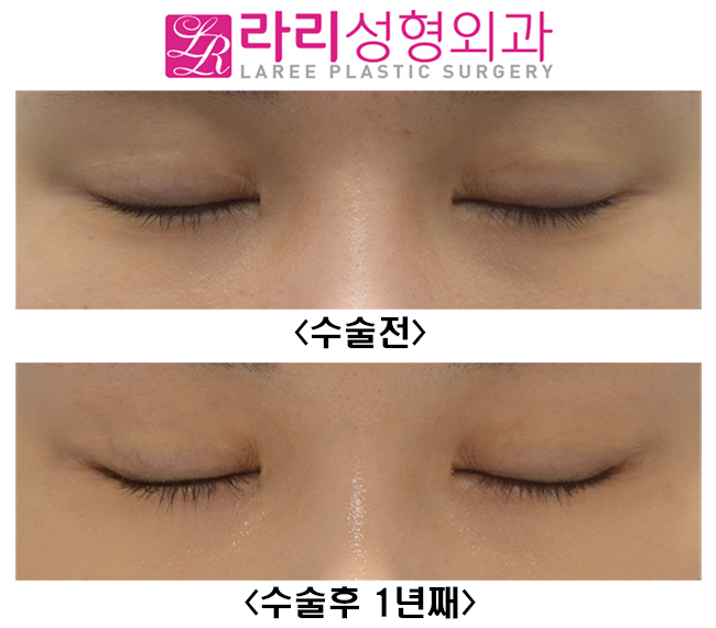 [라리성형외과] 뒤트임수술 첫 수술에 효과적으로 성공하기 관련 이미지 4
