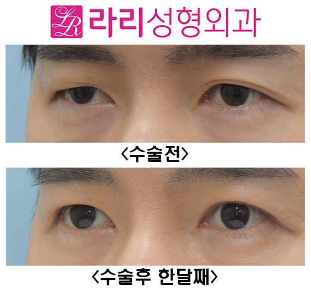 [Larie Plastic Surgery] Surgery to Remove Double Eyelids and Short-Term One-Month Progress Before and After Eye Correction Surgery image 4