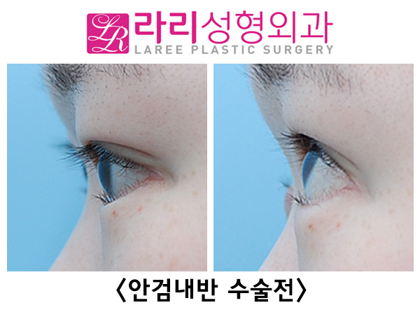 [Lari Plastic Surgery] Lower blepharoplasty including entropion correction, the most common cause of iatrogenic ectropion image 1