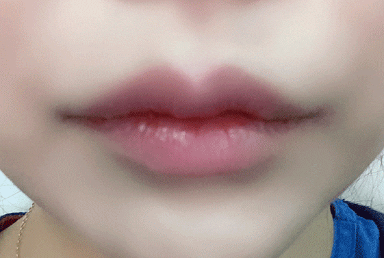 How to Make the Corners of the Mouth Lift Beautifully with Lip Corner Filler image 10