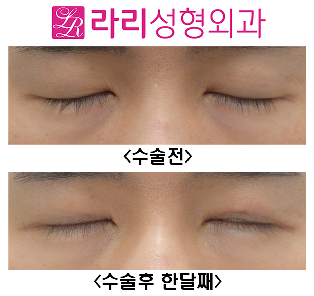 [Larie Plastic Surgery] Surgery to Remove Double Eyelids and Short-Term One-Month Progress Before and After Eye Correction Surgery image 5