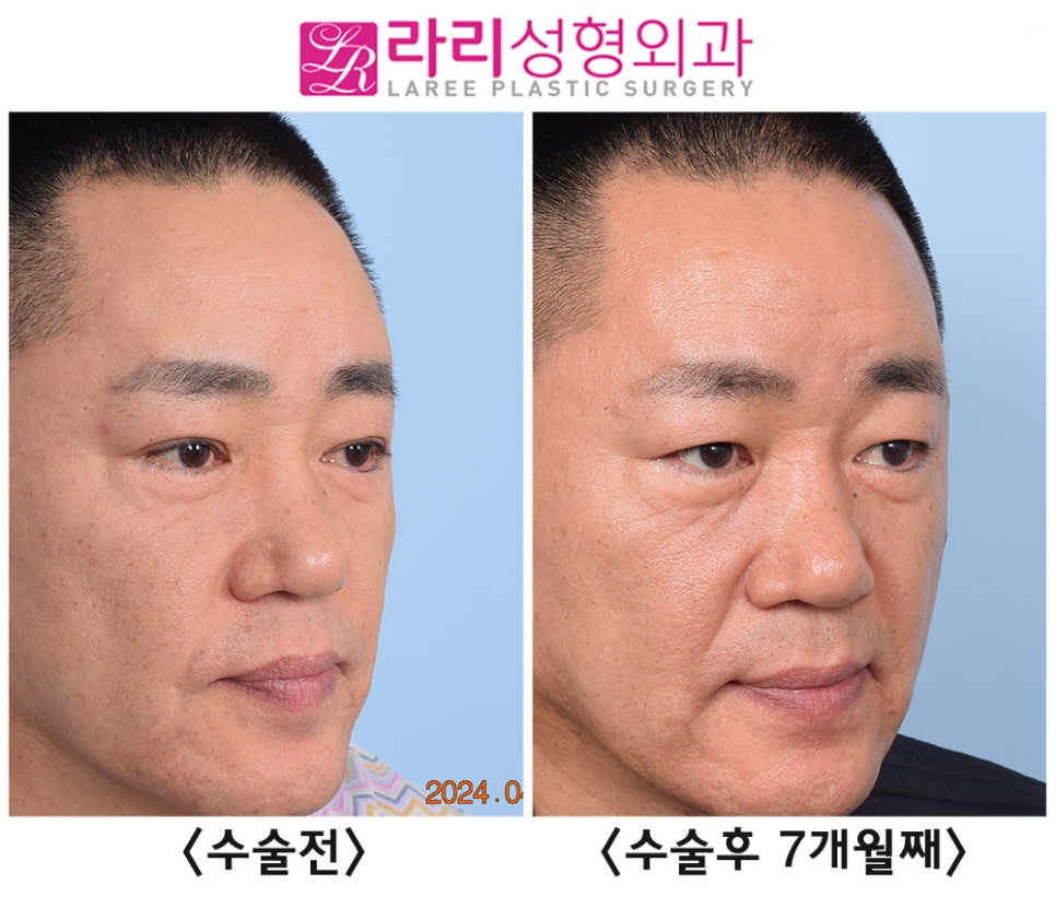 [Rari Plastic Surgery] Comparing Before and After Photos of Double Eyelid Removal Surgery (Double Eyelid Disappearance + Mucosal Ptosis Correction) image 1