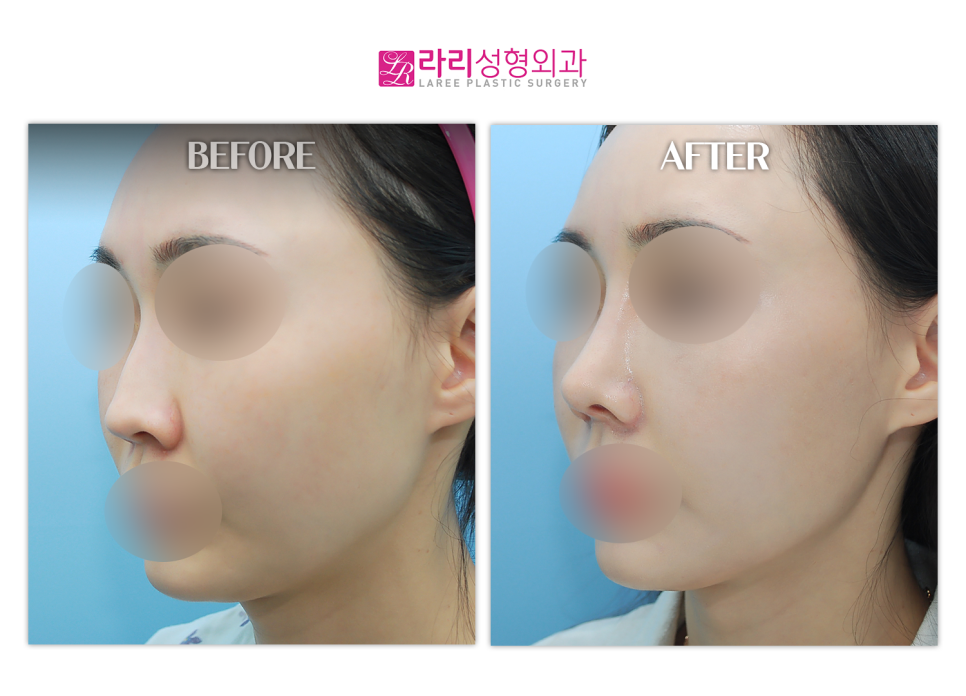 [Lari Plastic Surgery] Bridge Augmentation, Tip Plasty (Septal Cartilage), Hump Correction, Lateral Osteotomy, Alar Reduction image 2