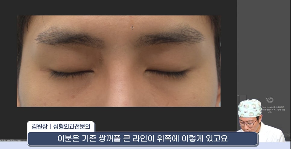 [라리성형외과] 쌍꺼풀재수술 라인 낮추는 두 가지 수술법 (절제방법 , 두줄따기방법) 관련 이미지 5