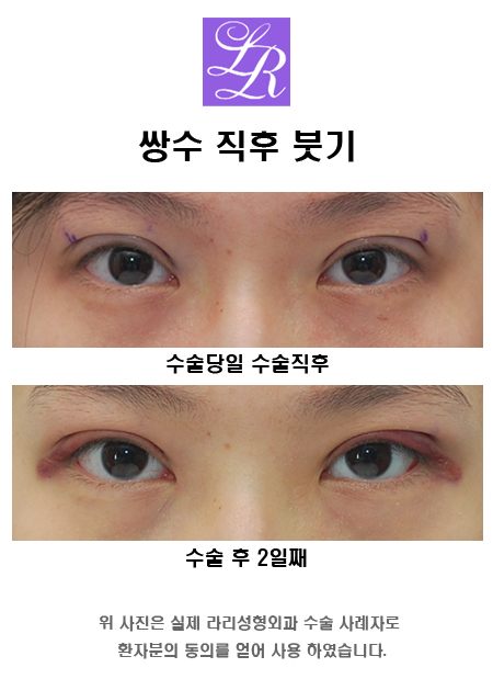Double Eyelid Burden After Buried Sutures - What Is It Like on Day 2? image 3