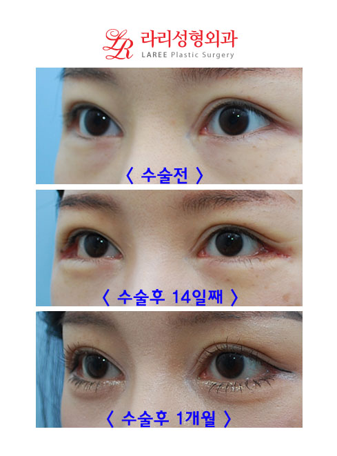 뒷트임재수술, 눈밑지방재배치 콜라보 관련 이미지 3